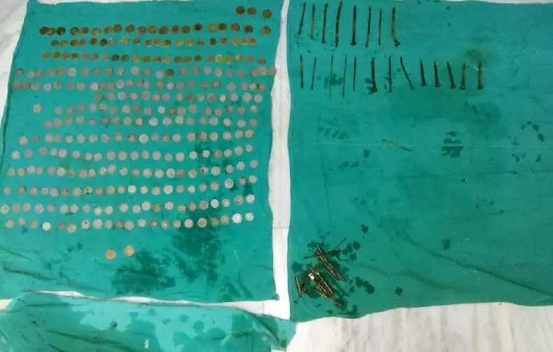 Un bărbat a mâncat sute de monede, 1,5 kilograme de cuie, zeci de lame și pietre