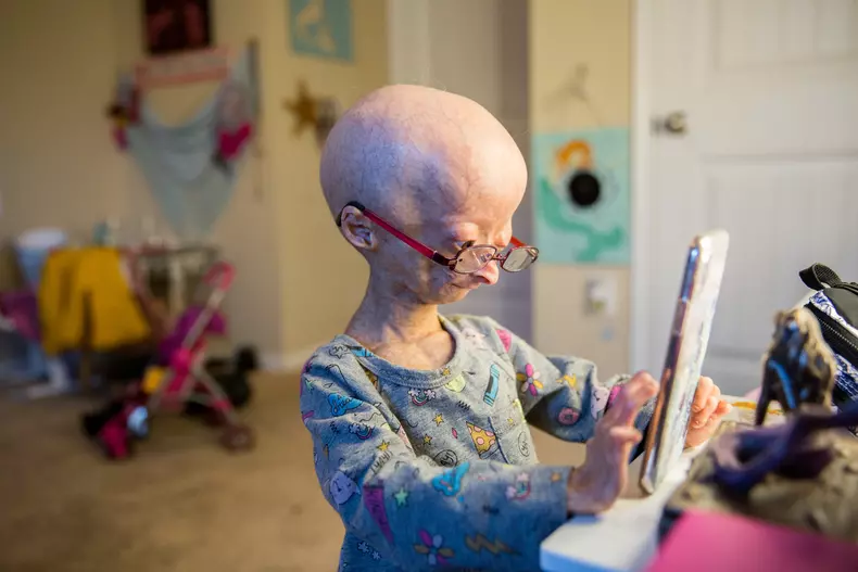 Adalia Rose: The Girl Who Ages Too Fast