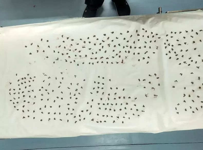 Doctorii indieni au reușit să scoată 4.100 de pietre din vezica biliară a unui bărbat