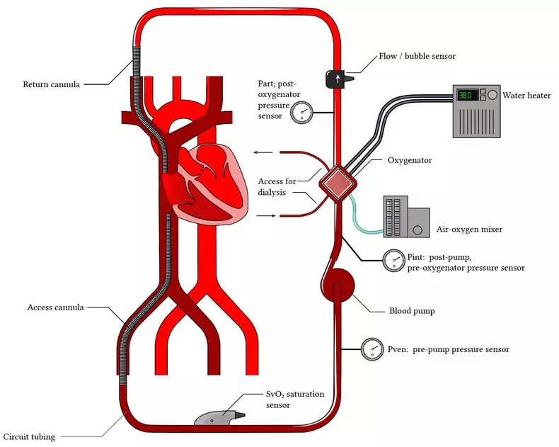ECMO - interventie medicala invaziva