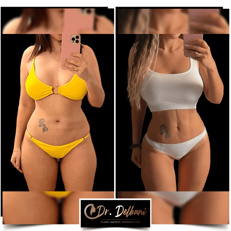 liposuctie-abdominala-dr-delbani
