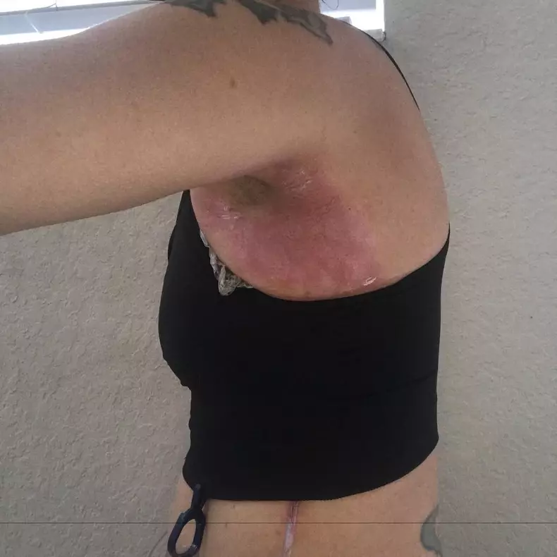 Toxic Breast Implants ***EXCLUSIVE***