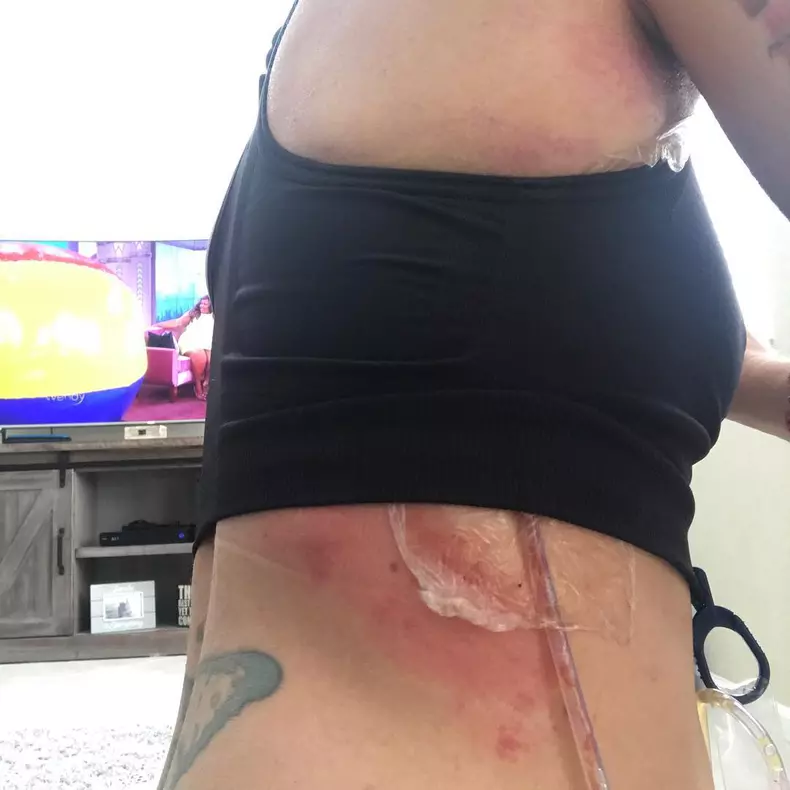 Toxic Breast Implants ***EXCLUSIVE***