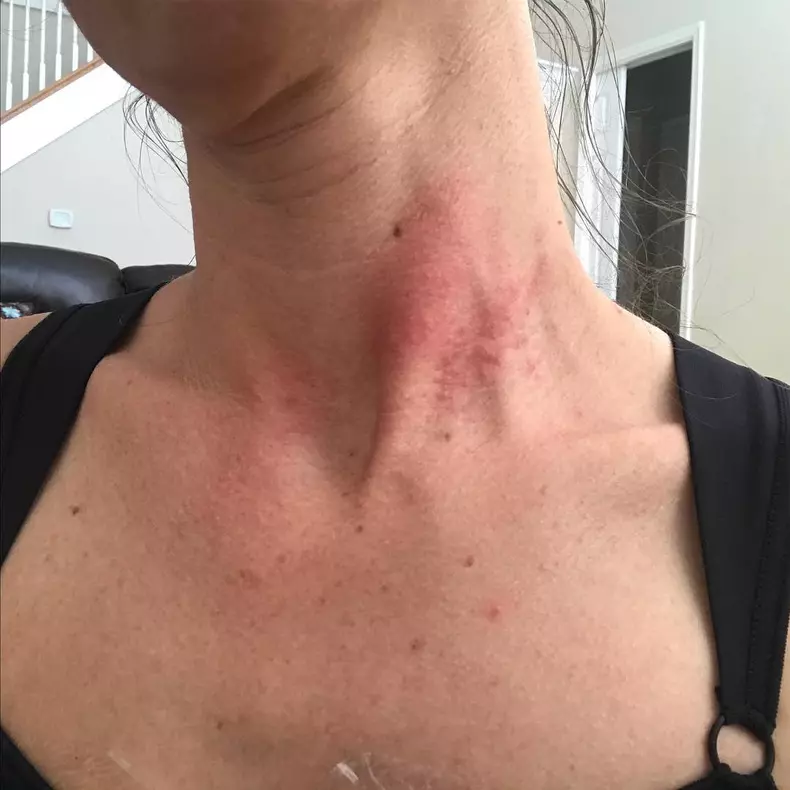 Toxic Breast Implants ***EXCLUSIVE***