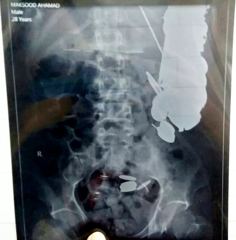 Un bărbat a mâncat sute de monede, 1,5 kilograme de cuie, zeci de lame și pietre