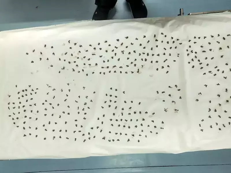 Doctorii indieni au reușit să scoată 4.100 de pietre din vezica biliară a unui bărbat