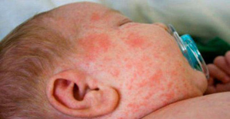 Aproape 60 De Cazuri Noi De Rujeolă în Ultima Săptămână în Total