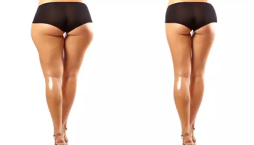 Tratamentul care ”topește grăsimile”, din ce în ce mai căutat de vedetele de la noi