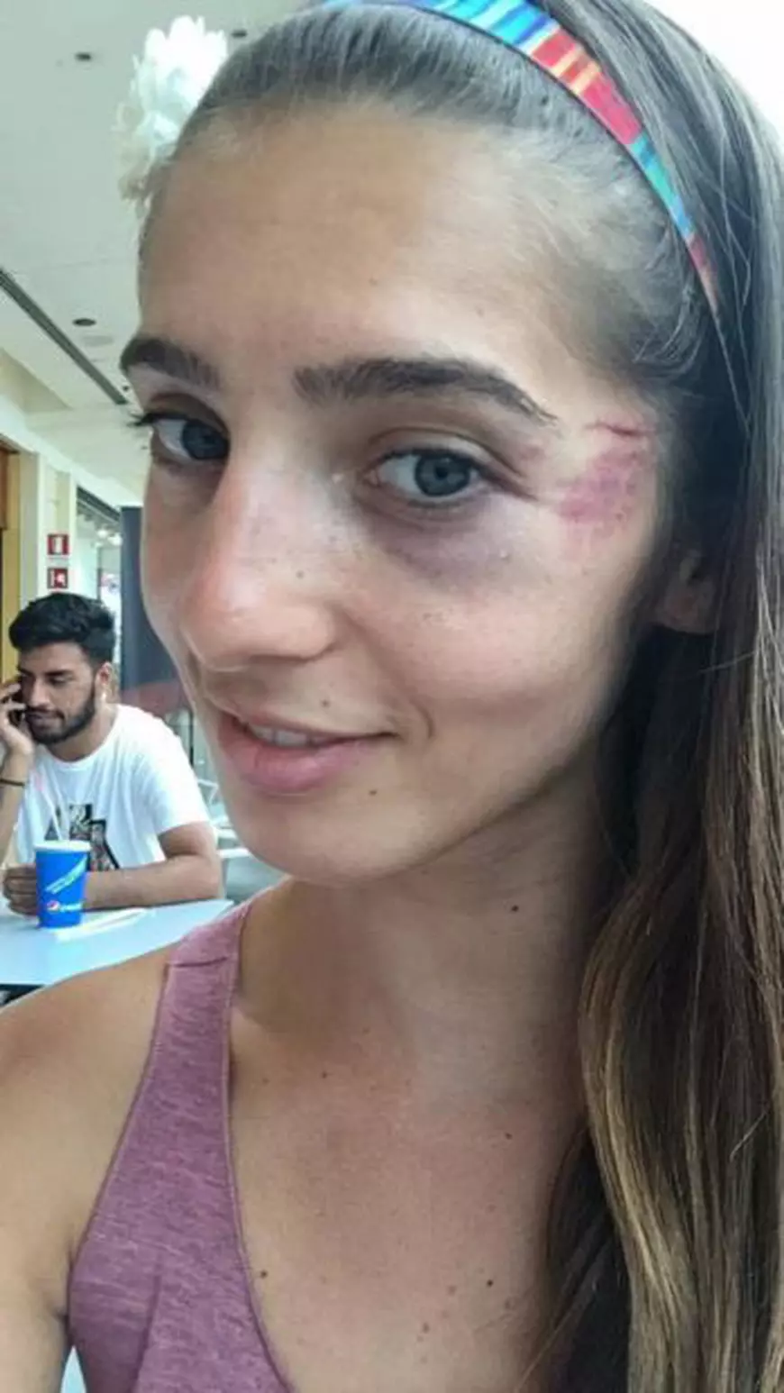Imagini șocante cu Iulia Găinariu, bronz mondial la alergare montană: mână luxată, ochi tumefiat, sângele șiroindu-i pe față | FOTO ÎN INTERIOR