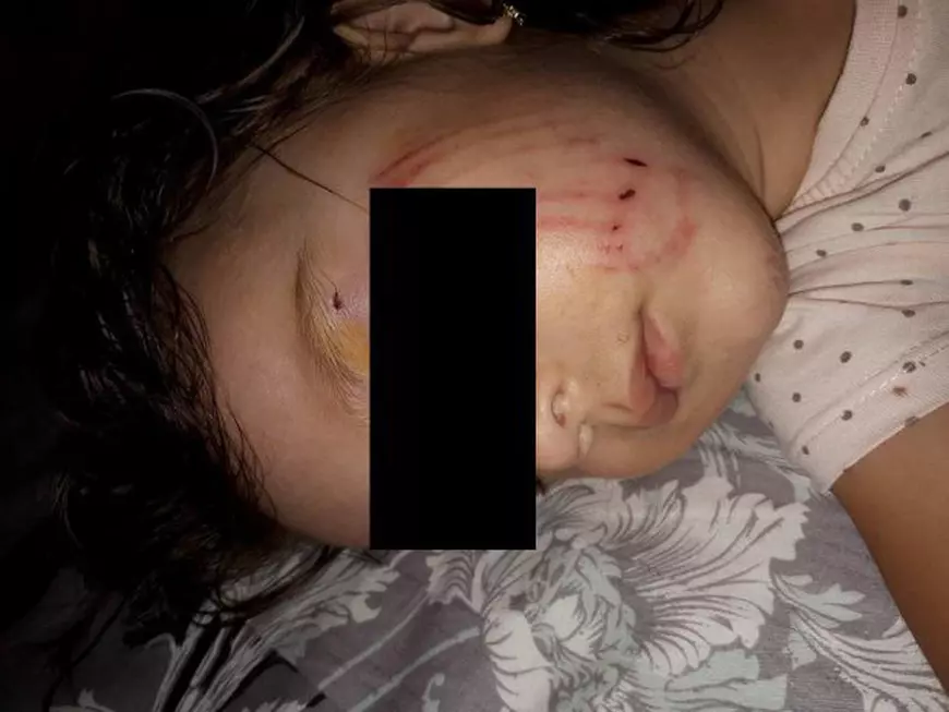 Fetiţă de doi ani atacată de un câine într-un parc din Buzău. Imaginea copilei pline de zgârieturi a devenit virală|FOTO