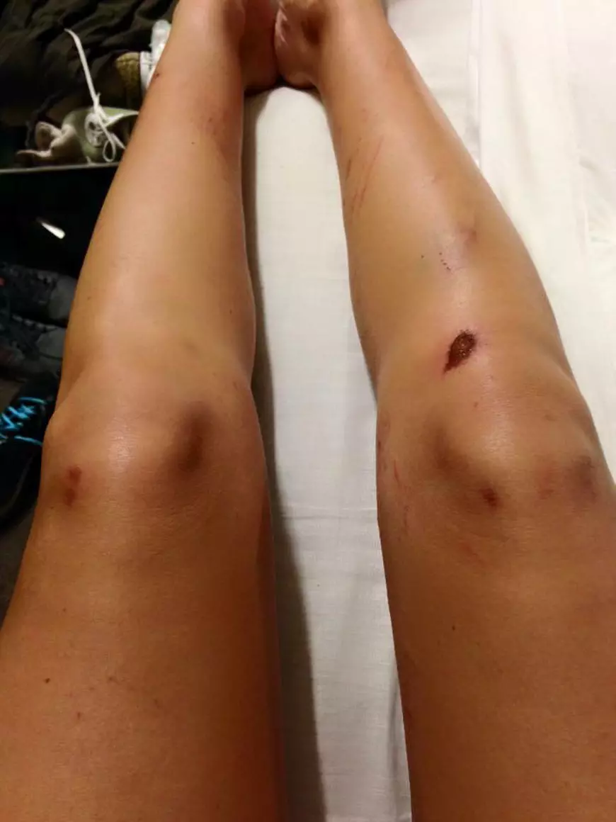 Cea mai șocantă imagine cu picioarele Denisei de la Bambi. Plină de răni, zgârieturi și vânătăi