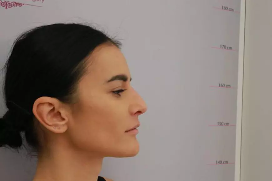 FOTO EXCLUSIV/RUX de la LikeOne și-a făcut operație estetică. „Mereu am avut un complex legat de...”