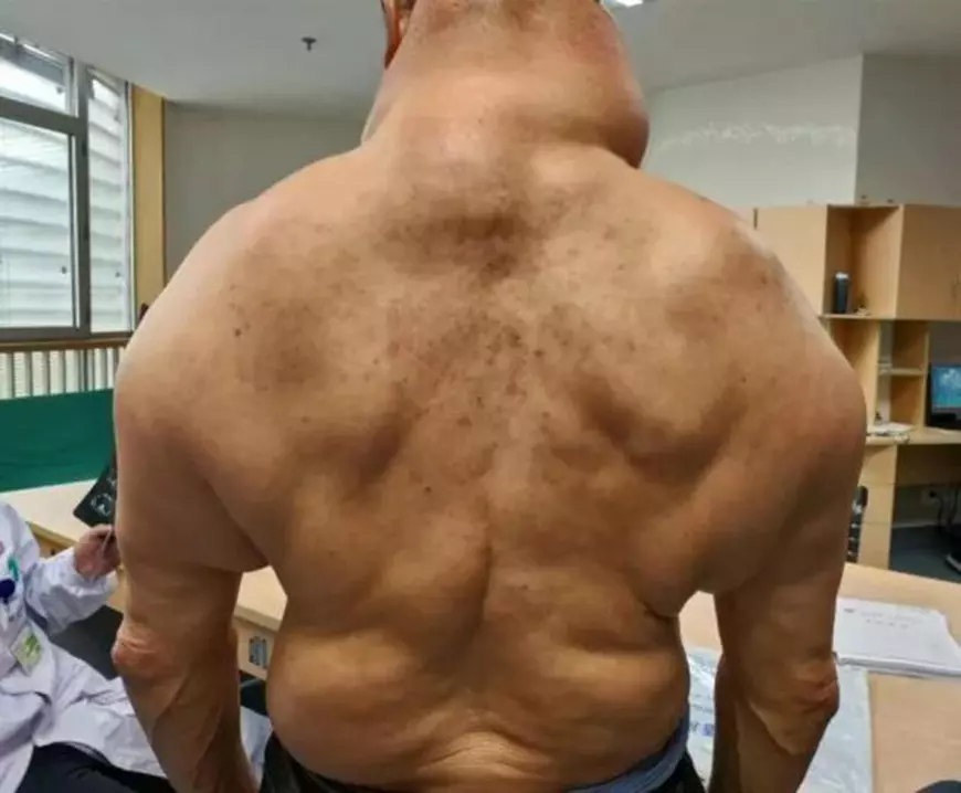 FOTO | Cum arată "Hulk", un pensionar care a consumat alcool în fiecare zi, timp de 30 de ani