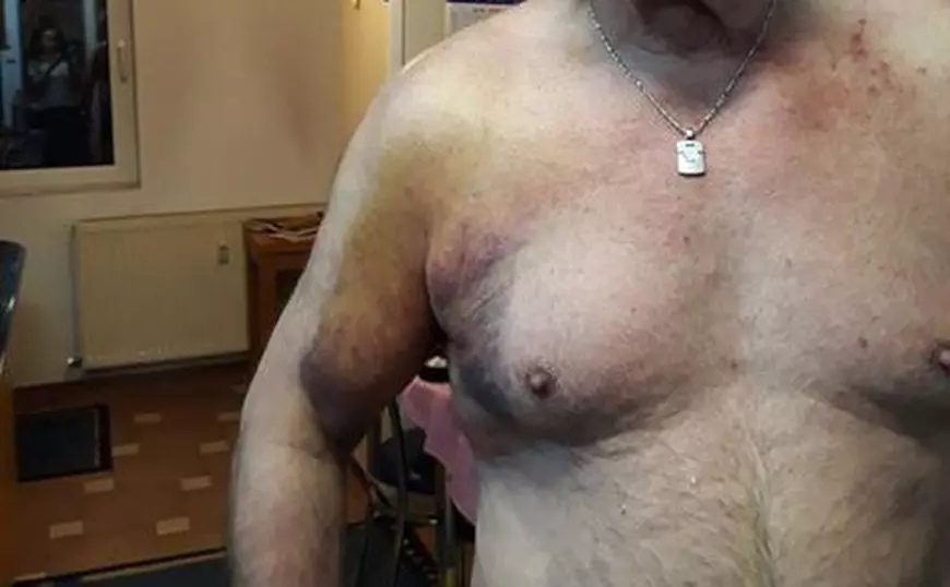 Medicul pensionar Liciniu Miculeanu își arată rănile de pe corp după ce a fost bătut de jandarmi