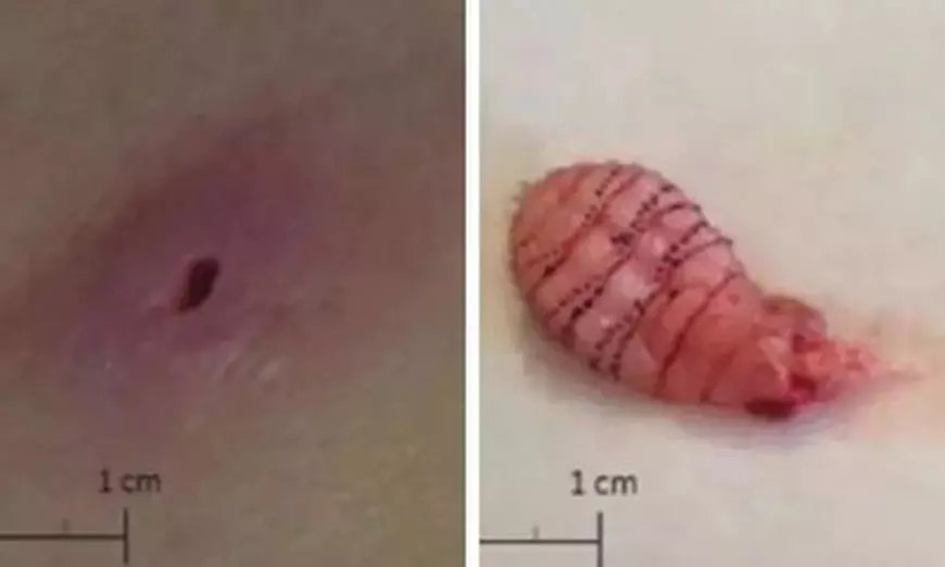 FOTO | Descoperire terifiantă sub pielea unei femei care abia se întorsese din luna de miere. Medicii au fost șocați