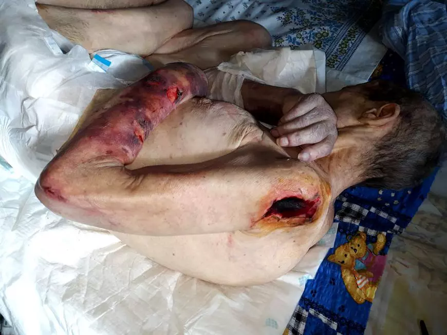 FOTO| Spitalul Pantelimon a externat un pacient aflat în stare critică. Imagini șocante cu femeia trimisă acasă, oferite de familie Libertății