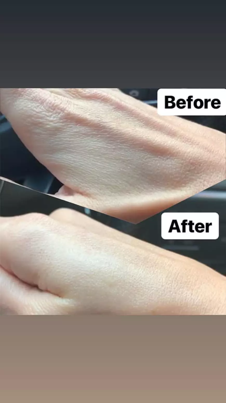 Cum arată mâna Denisei Tănase de la trupa Bambi. "Recunosc că m-a șocat până și pe mine"