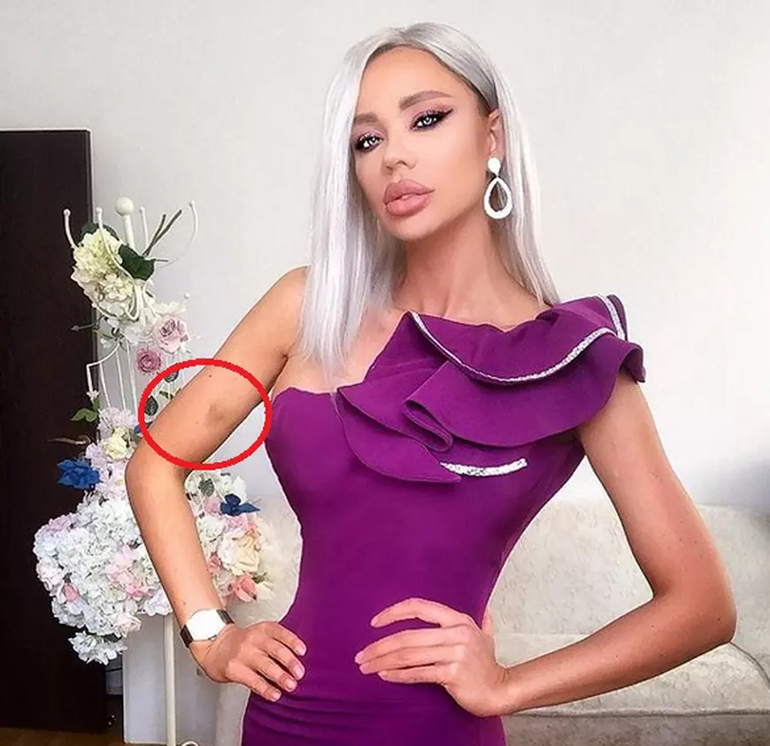 Bianca Drăgușanu, plină de vânătăi după despărțirea de Alex Bodi. „Probabil că el va încerca să nege că a fost violent”