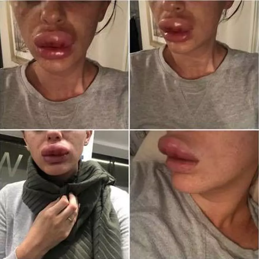 Buzele unei tinere din Marea Britanie, la un pas de a exploda după injecțiile cu Botox. Asistentele au râs de ea când a ajuns la spital / FOTO&VIDEO