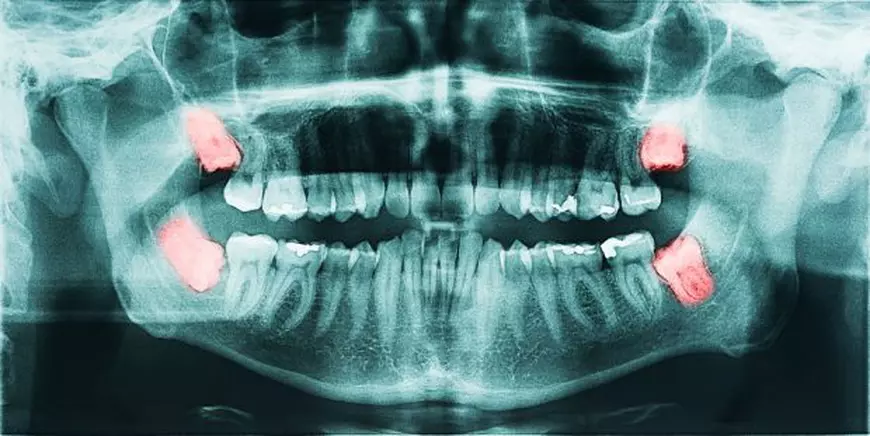 Fotografie cu radiografia măselelor de minte