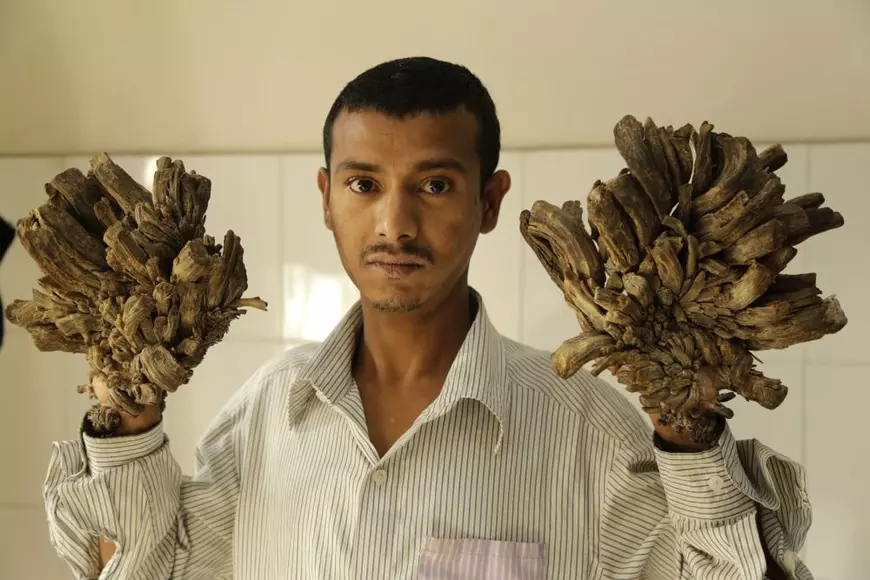 „Omul-copac” din Bangladesh vrea să-i fie amputate mâinile. Chinul pe care-l îndură din cauza unei boli rare / FOTO&VIDEO