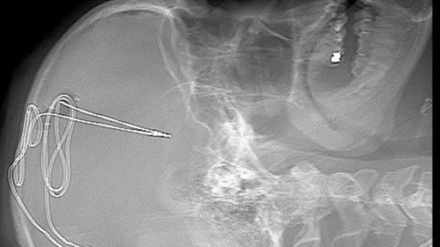 Experiment în premieră, în Statele Unite. Un implant în creier e folosit pentru a combate dependența de droguri