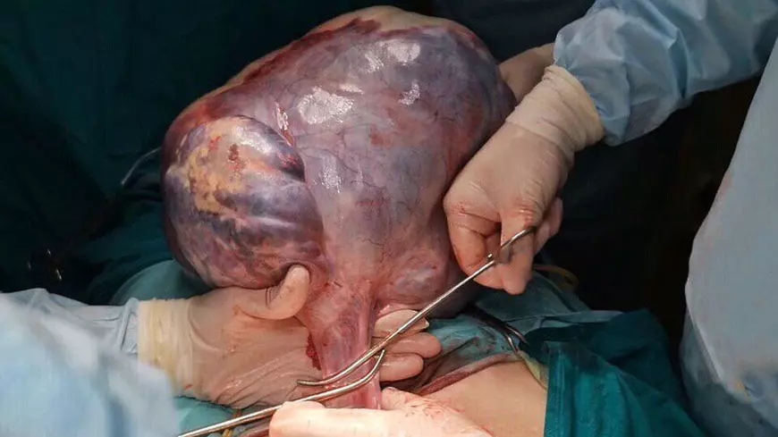 O femeie din Rusia a stat cu o tumoare uriașă în corp timp de 20 de ani. S-a dus la spital pentru că se îngrășa fără să mănânce nimic