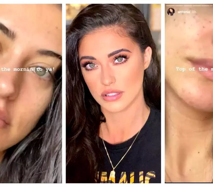 Antonia și-a făcut o nouă intervenție estetică la față. Cum arată artista acum