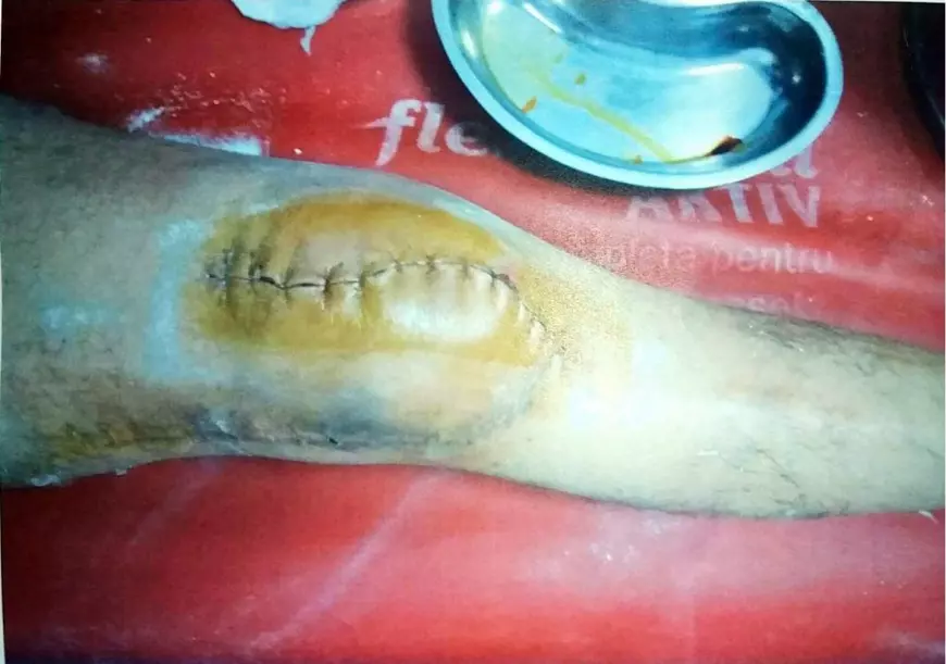 Cum a fost tărăgănat mai bine de un an dosarul unui avocat care s-a ales cu piciorul rupt după ce a reprezentat o clientă