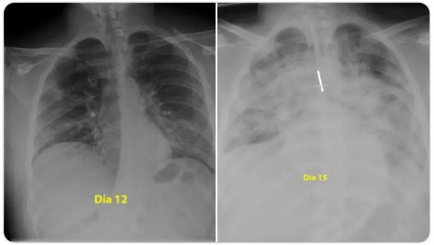 Cum arată plămânii unui tânăr de 28 de ani infectat cu coronavirus. În trei zile a fost intubat