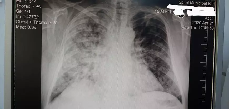 Un medic a publicat radiografia unui pacient infectat cu coronavirus: “Am avut cazuri mult mai grave”