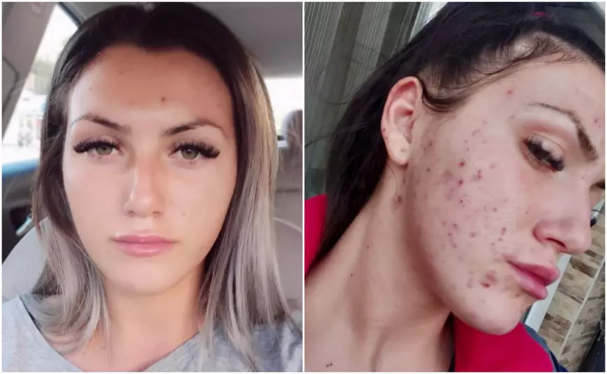 Deși zeci de tinere au acuzat că le-au distrus tenul, influenceri și vedete nu se dezic de produsele Plush Bio. Dorian Popa e cel mai vehement apărător, dar nu a folosit cremele cu probleme