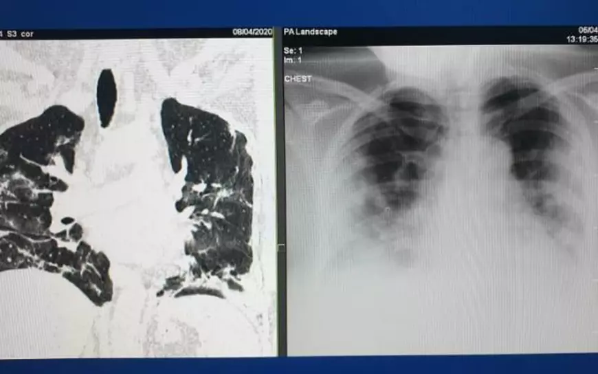 Concluziile îngrijorătoare ale unui medic radiolog din Cluj despre pacienții cu COVID: „În 90% din cazuri, evoluția înseamnă o pneumonie bilaterală”