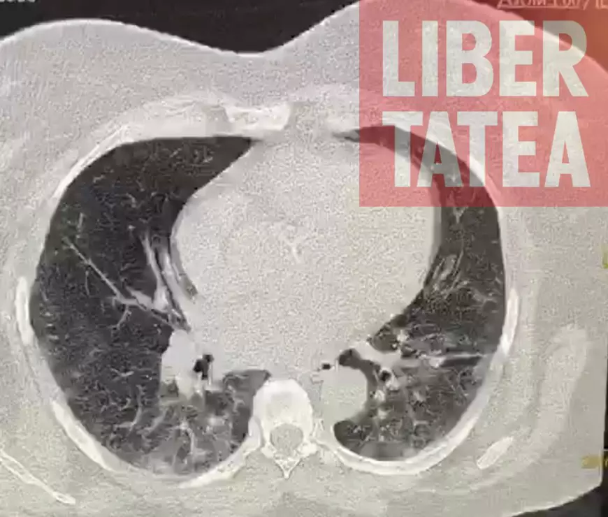 FOTO | Cum arată plămânii unui bolnav de COVID-19, în formă moderată și critică. Directorul Spitalului ”Marius Nasta” recunoaște că nu au găsit metoda să explice tinerilor