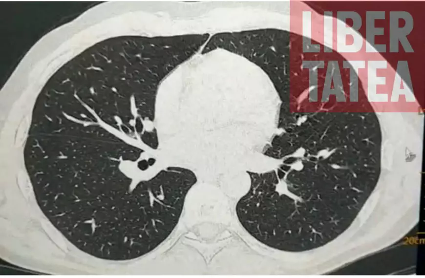 FOTO | Cum arată plămânii unui bolnav de COVID-19, în formă moderată și critică. Directorul Spitalului ”Marius Nasta” recunoaște că nu au găsit metoda să explice tinerilor