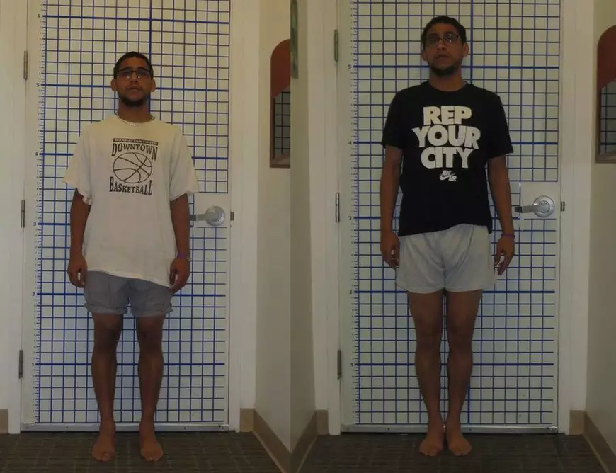 Tot mai mulți oameni se operează pentru lungirea picioarelor. Clienții vor să fie mai înalți, în ciuda costurilor și durerii