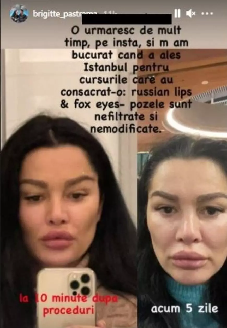 Brigitte Pastramă a apelat din nou la medicul estetician, iar transformarea este șocantă. Vedeta și-a făcut „buze rusești”. „Sunt mai mari decât înainte”