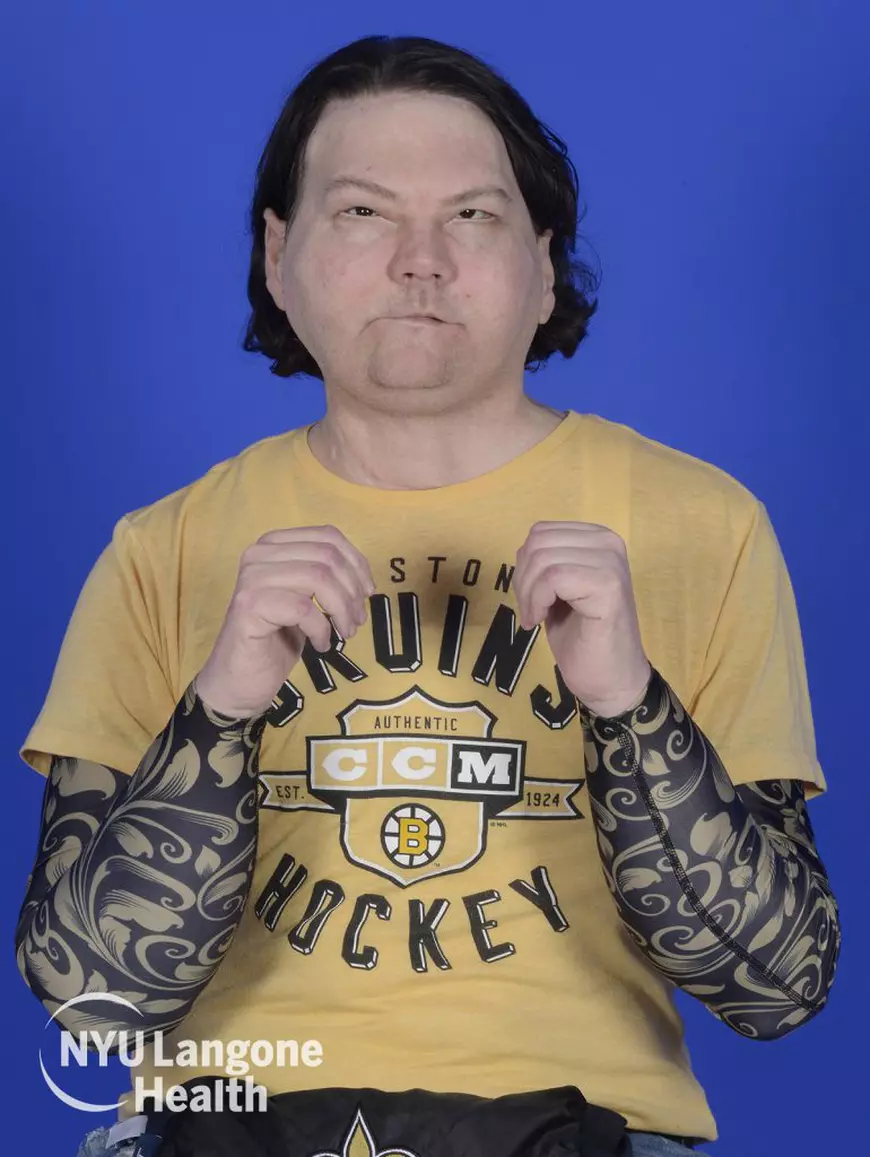 Tânărul căruia i-a explodat mașina și a fost ars aproape complet a primit o nouă față și două mâini noi, după primul transplant din lume de acest fel reușit