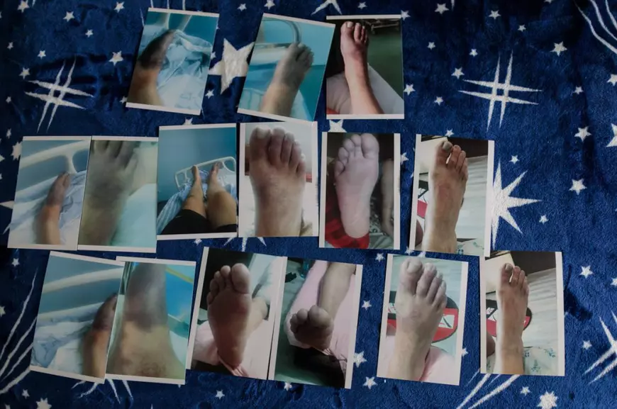 Rămas fără un picior după COVID, un bărbat îi acuză de neglijență pe medicii infecționiști de la spitalul din Slatina