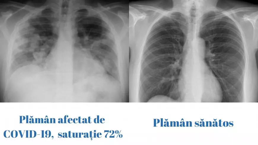 Cum arată un plămân afectat de COVID-19 faţă de un plămân sănătos. Avertismentul medicilor