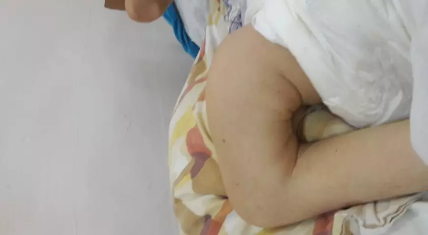 CAZ ȘOCANT. O tânără cu handicap grav dintr-un centru din Vâlcea, ținută jumătate de an cu piciorul rupt. Conducerea: „Nu este caz de urgență”