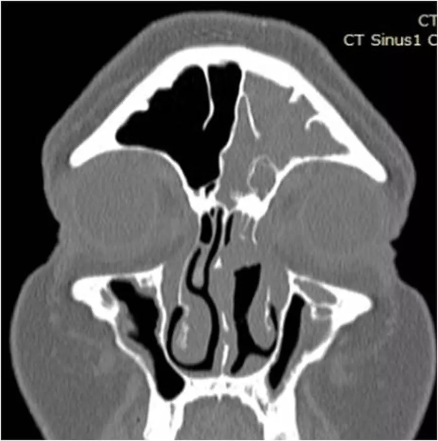A doua șansă la o viață normală: chirurgia endoscopică de revizie pentru a scăpa definitiv de sinuzită