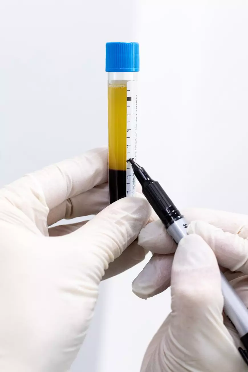 Cum ajută tehnologia PRGF în tratamentul cu dinți ficși?