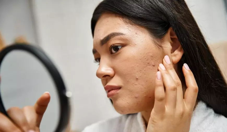 Femeie cu acnee care se uită în oglindă